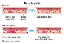thrombofilia
