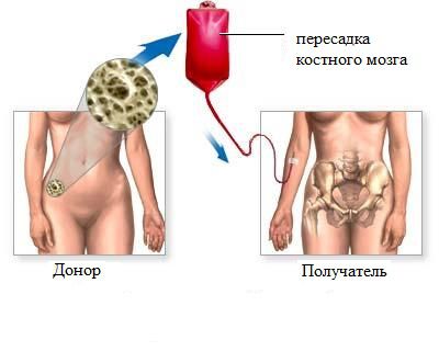 transplantaciya